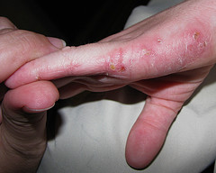 eczema