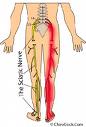 sciatica